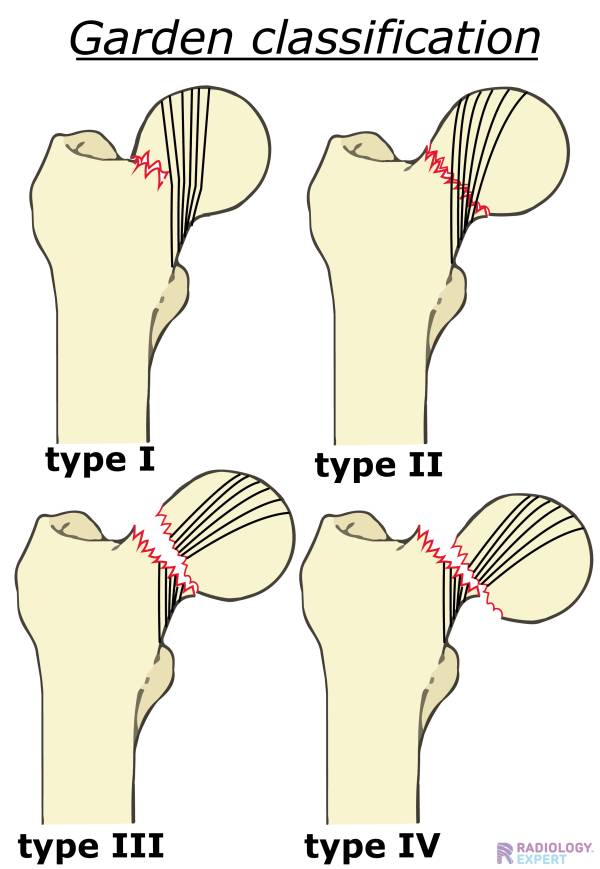 Garden Classification of Femoral Neck Fractures😦 Descubra a emoção de